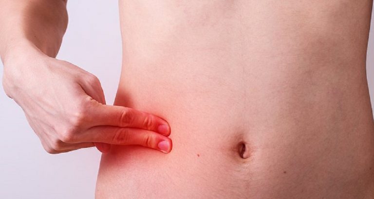 Read more about the article Appendectomy