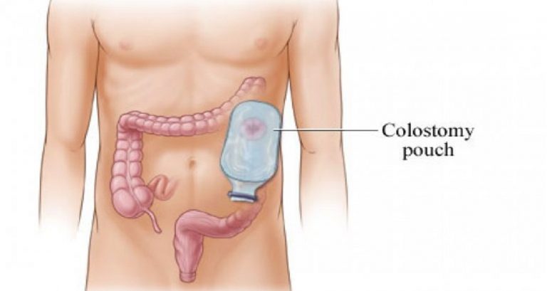 Colostomy