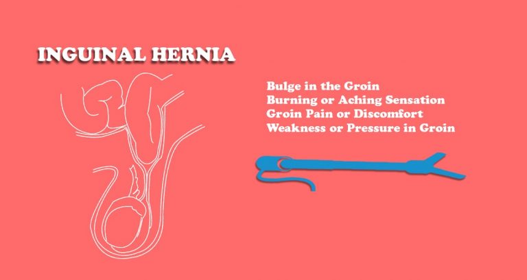  Inguinal Hernia