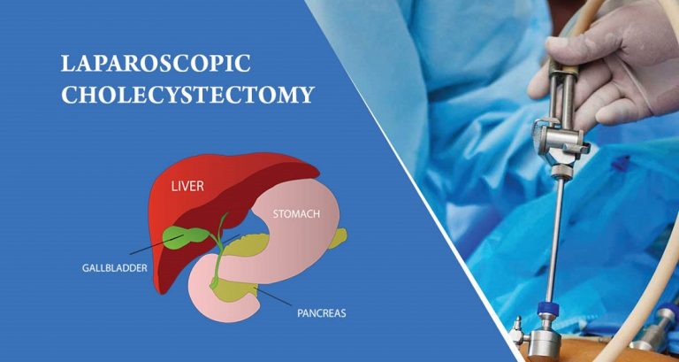 Cholecystectomy