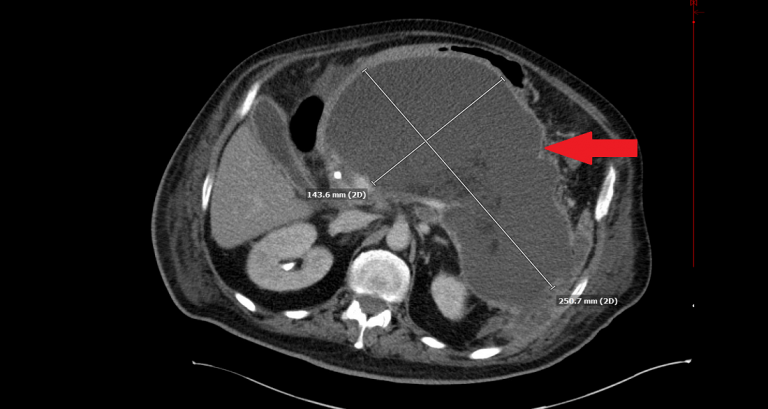 Pancreatic Pseudocyst