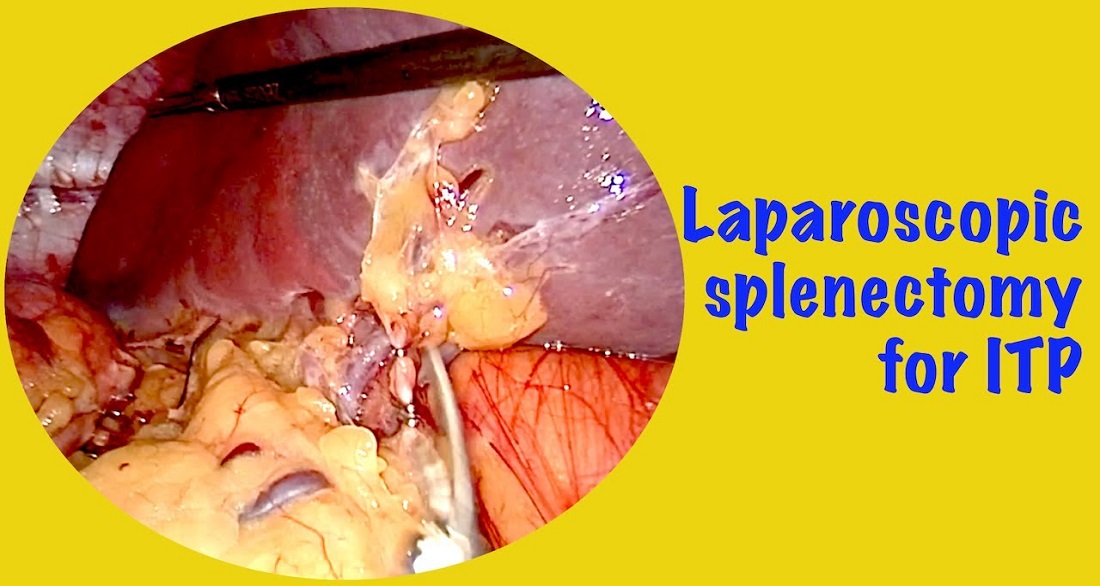 You are currently viewing Splenectomy