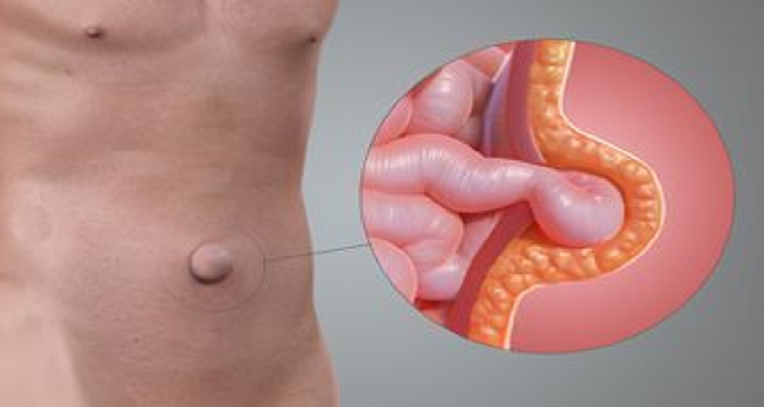 You are currently viewing Umbilical Hernia