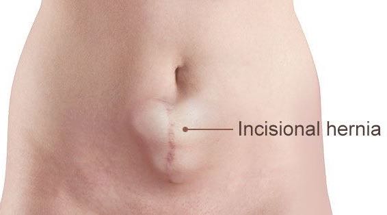 Incisional Hernia Surgery