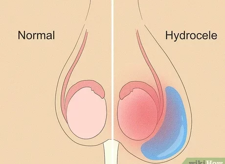 Hydrocele
